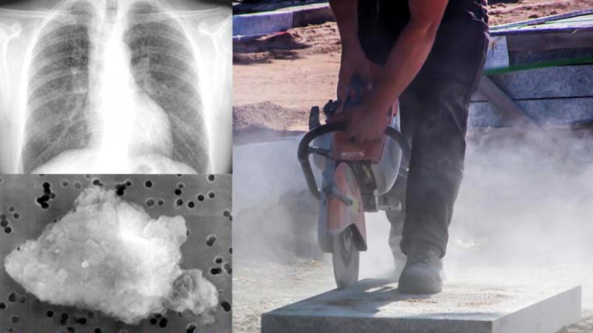 España sufre una reemergencia de la silicosis España sufre una reemergencia de la silicosis